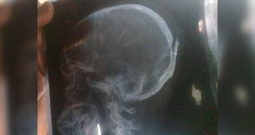 La víctima sufrió considerables afectaciones en su cráneo. Foto: Cortesía/Radio ABC Stereo